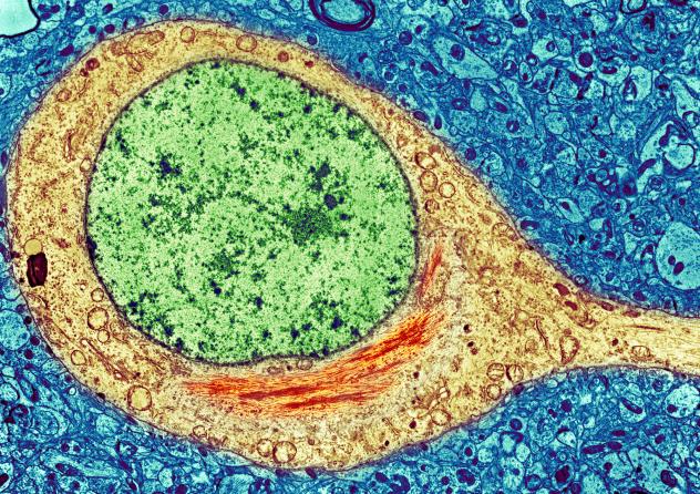 In this colorized image of a brain cell from a person with Alzheimer's the red tangle in the yellow cell body is a toxic tangle of misfolded'tau proteins adjacent to the cell's green nucleus