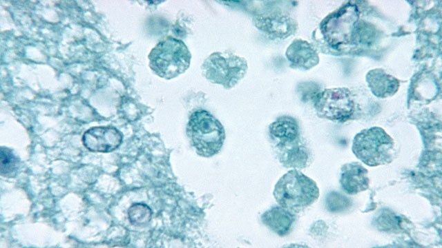 Naegleria fowleri