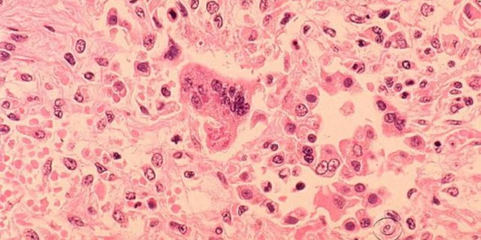 Clallam Co. woman first to die from measles in U.S. since 2003 | Local