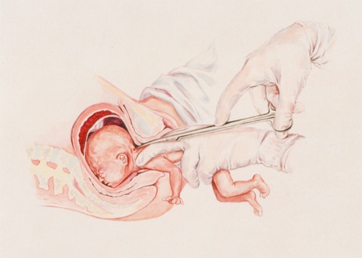 Medial diagram of a partial-birth abortion procedure where the child is delivered breech except for the head