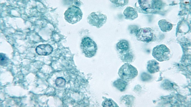 Dangerous brain-eating amoeba found in Ascension Parish