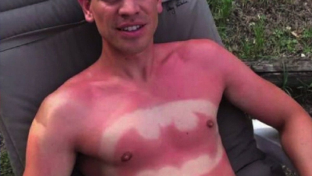 Featured image for Sunburn Art Is Now A Trend A Really Dumb Trend