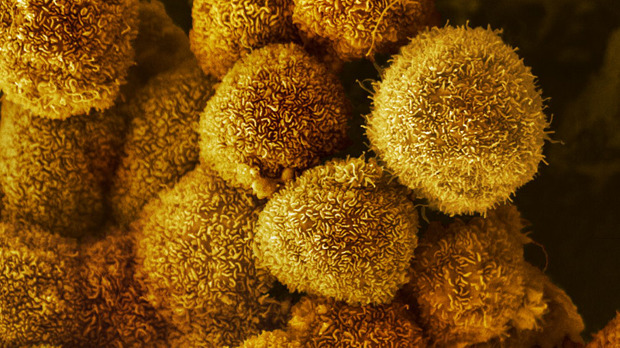 Pancreatic cancer cells- image courtesy of the London Research Institute EM Unit