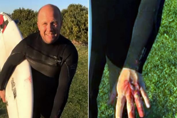 Great White Shark Bites Surfer 'To The Bone' In Australia