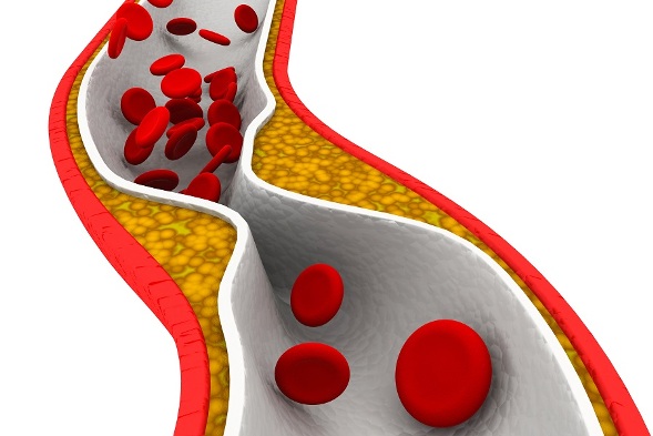 Cholesterol plaque in artery