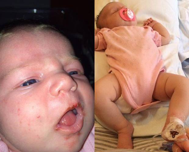 A warning for parents — a kiss nearly killed this baby