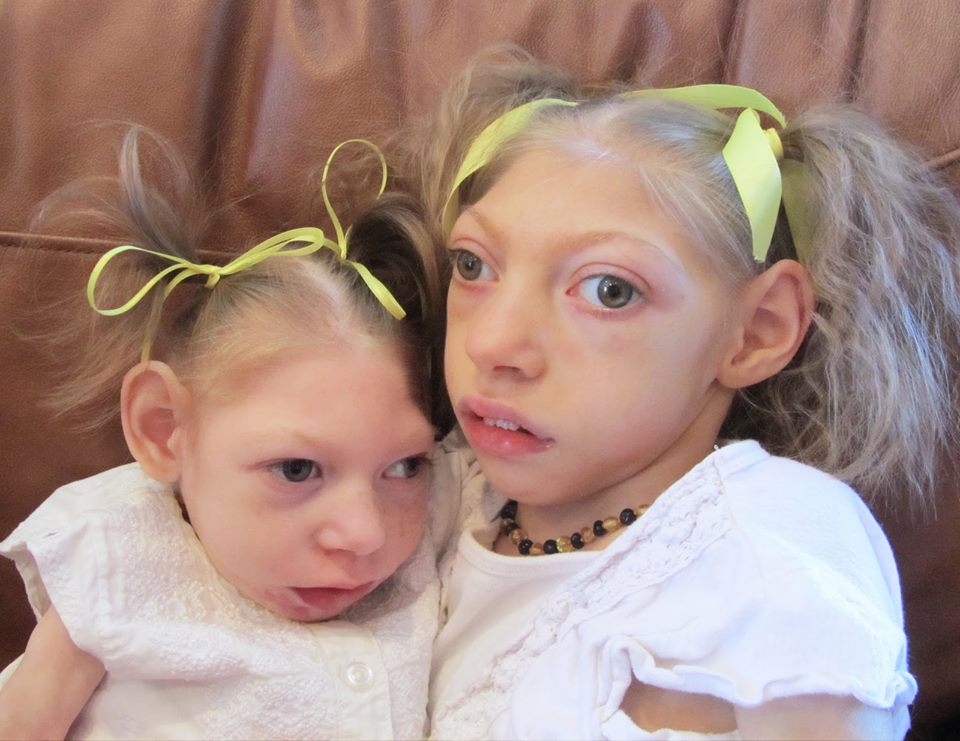 Children Born With Microcephaly