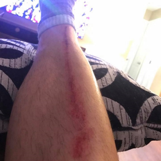 Patriots Fan's Injured Leg