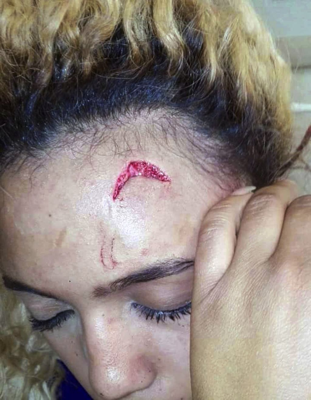 Gabriella Engels is seen with an injury to her forehead in Johannesburg South Africa