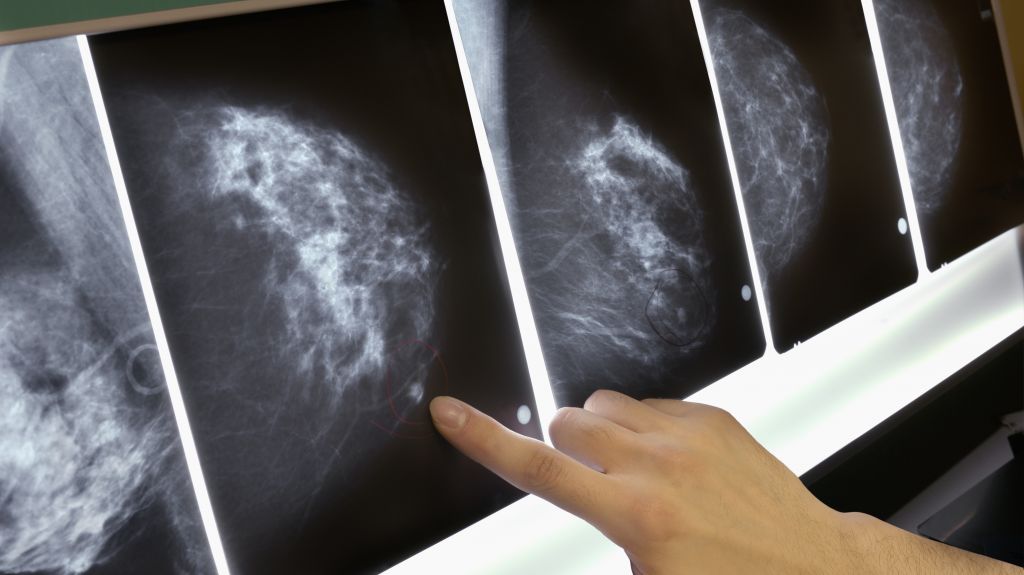 Women with a common form of breast cancer may be able to safely forgo chemotherapy depending on the results of a genetic test