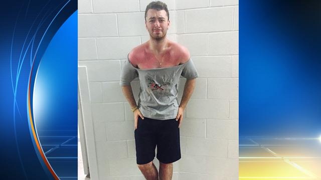 Instagram/@samsmithworld     
            Sam Smith shows off the sunburn he got while in Miami for a concert