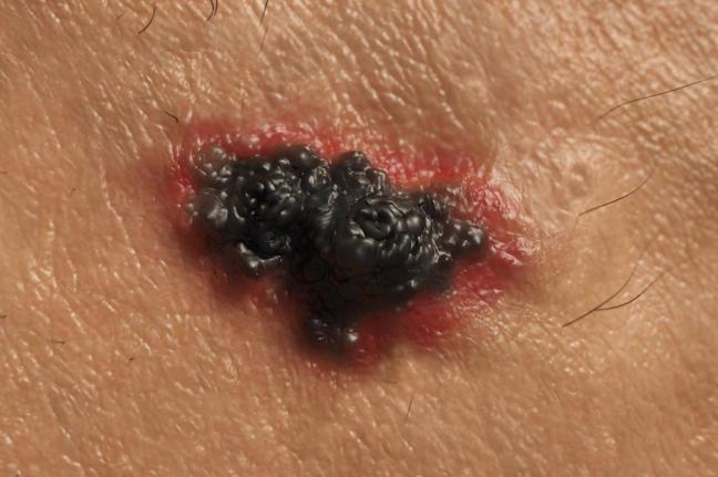 Odomzo Approved for Advanced Skin Cancer - MPR