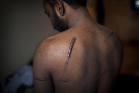 An ethnic Tamil survivor of alleged torture at the hands of Sri Lankan security forces