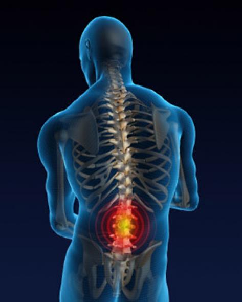 Steroid Shots Alleviate Lower Back Pain Temporarily