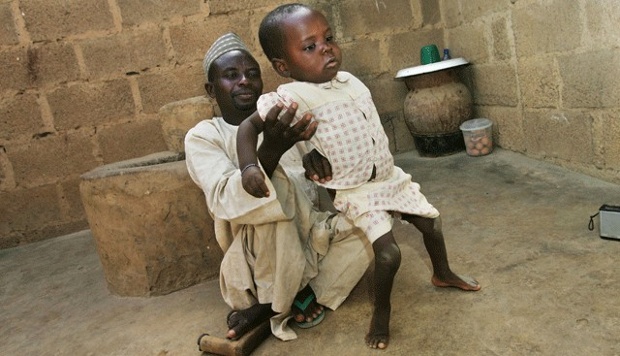 Child afflicted with polio in 2005