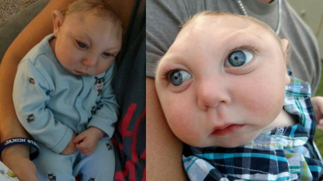 In pics Baby born without large part of skull and brain completes one year