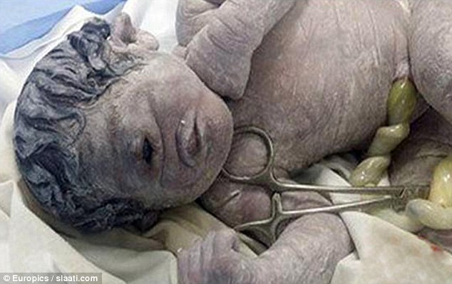 A baby has been born in Egypt with the rare birth defect cyclopia. The condition named after the one-eyed giants in Greek mythology means the newborn boy has only one eye in the place where his nose should