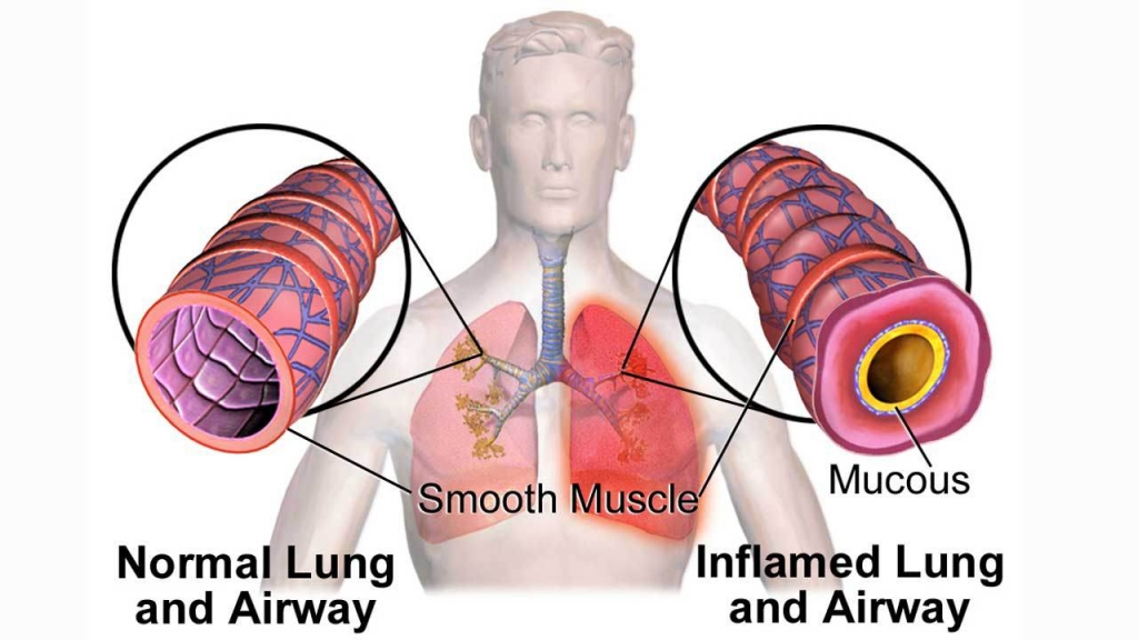 Canadian study identifies 'critical window' for developing asthma