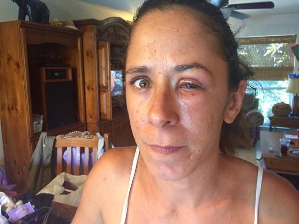 Woman mistakes glue for eye drops, glues eye shut