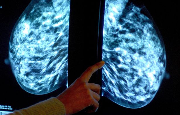 Pertuzumab drug for early breast cancer licensed