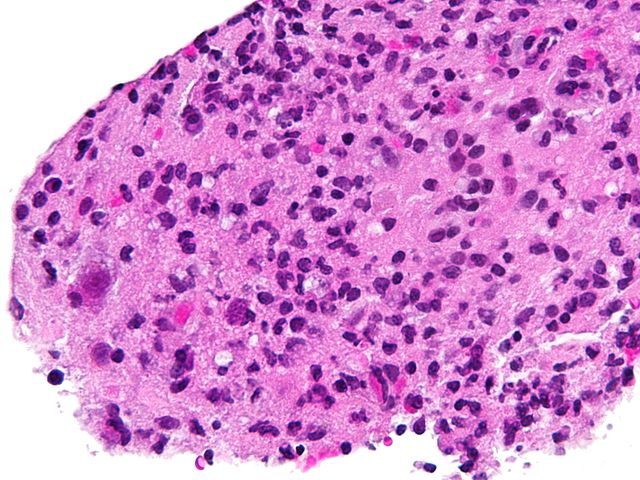 Toxoplasmosis- cropped- very high