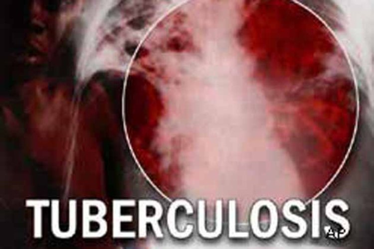 Tuberculosis now rivals AIDS as leading cause of death -WHO