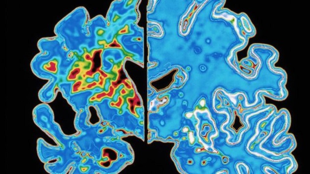 Brain Differences Seen in Young Adults at Genetic Risk of Alzheimer's