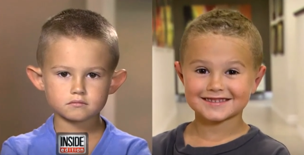 Why This 6-Year-Old Got Plastic Surgery