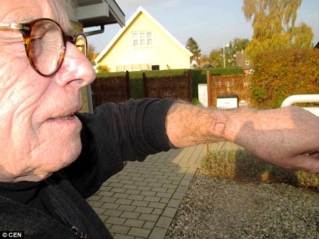 Danish man Jorgen Mourtizen who claims that his Apple watch burned through his skin after it started glowing with heat