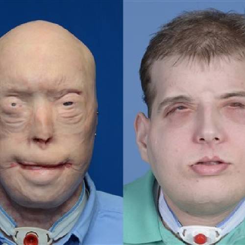 Volunteer firefighter receives face transplant