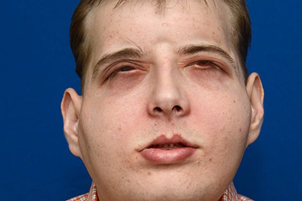 Face transplant patient Patrick Hardison after his surgery