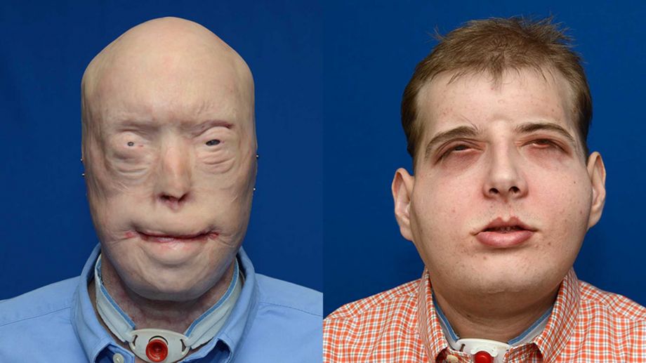 2015 by the NYU Langone Medical Center shows face transplant patient Patrick Hardison before and after his surgery. A New York medical center said