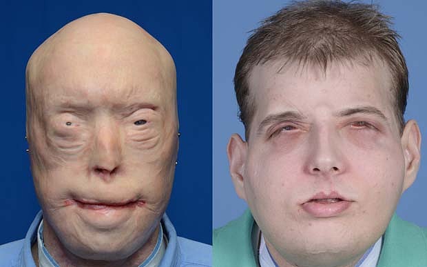 Patrick Hardison undergoes ‘most extensive face transplant in history