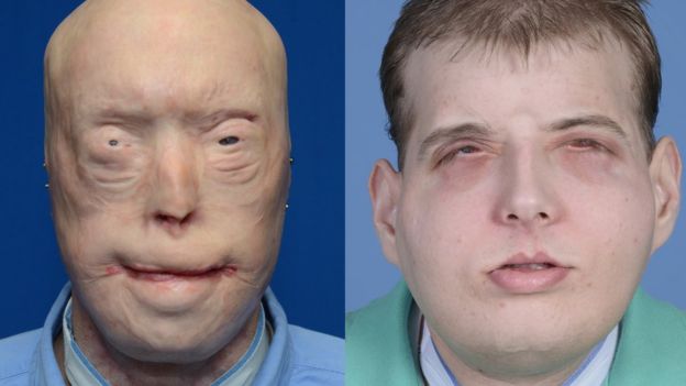 Patrick before and after his surgery. source BBC