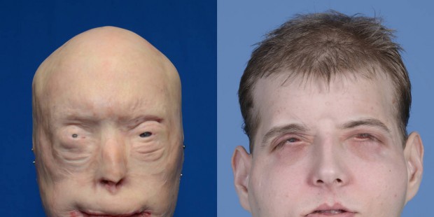 NYU Reports Most Extensive Face Transplant To Hero Firefighter