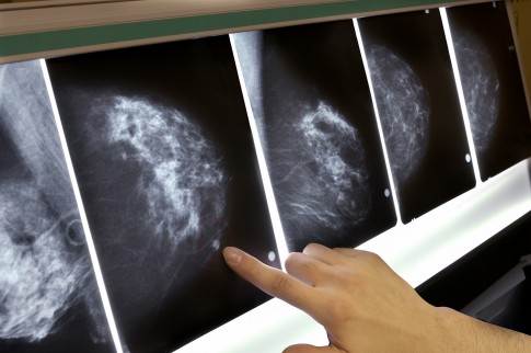 Depression 'raises risk of cancer death': Women with breast cancer who suffer