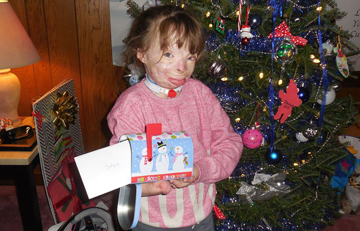 Burned girl's Christmas wish fulfilled