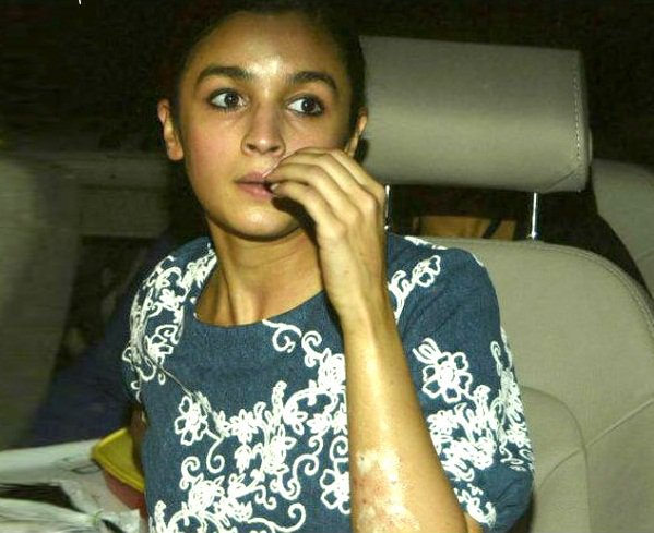 SHOCKING! See Here, Poor Alia Bhatt Suffers Multiple Burns On Her Face & Hands!