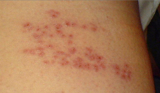 Shingles