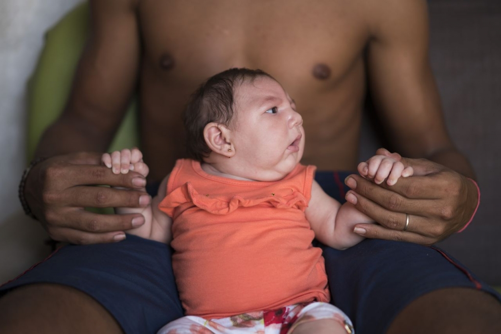 A child born in Brazil with microcephaly. Her mother was infected with the Zika virus while pregnant