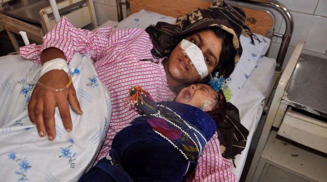 Afghan woman Reza Gul 20 and whose nose was sliced off by her husband in an attack lies on a bed with her baby as she receives treatment at a hospital in the northern province of Faryab