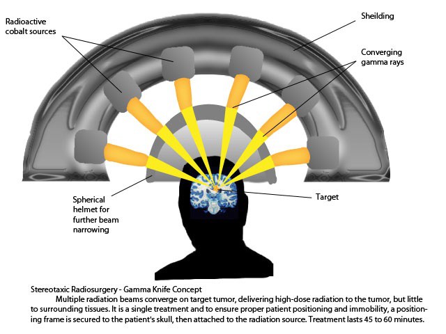 'gamma knife