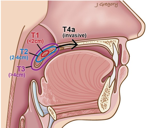 Oral sex CAUSES throat cancer, new research reveals after Michael Douglas blames HPV for illness