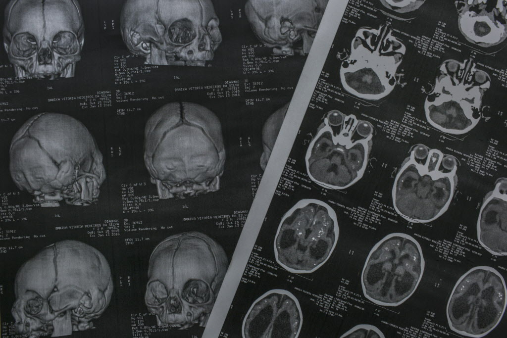 A tomography result of a three-month girl with microcephaly lies on a doctor's office at the Oswaldo Cruz Hospital in Recife Brazil Jan. 29 2016. Before last fall medical reports of babies born with microcephaly were so rare in Brazil that only about