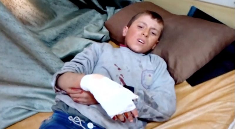 A boy lies on a bed with an injured hand after what is said to be a missile attack on a hospital in Azaz Aleppo Syria. Seven Russian missiles struck a hospital in the northern Syrian town of Azaz yesterday causing the civilian death toll to rise above