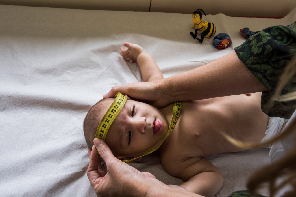 Dr. Vanessa Van Der Linden a neurologist at the Associacao de Assistencia a Crianca Deficiente measures the head of a baby with microcephaly in Recife Brazil Feb. 1 2016. This center has seen 69 children with microcephaly so far