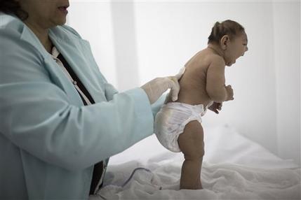 Lara who is less then 3-months old and was born with microcephaly is examined by a neurologist at the Pedro I hospital in Campina Grande Paraiba state Brazil. Scientists suspect an outbreak of the Zika virus