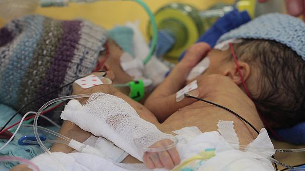 Doctors separate ‘smallest-ever’ conjoined twins