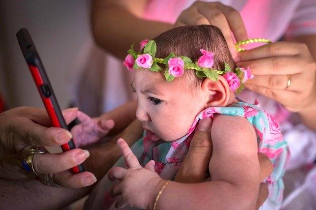 A baby girl with microcephaly a condition which may be linked to Zika
EFE