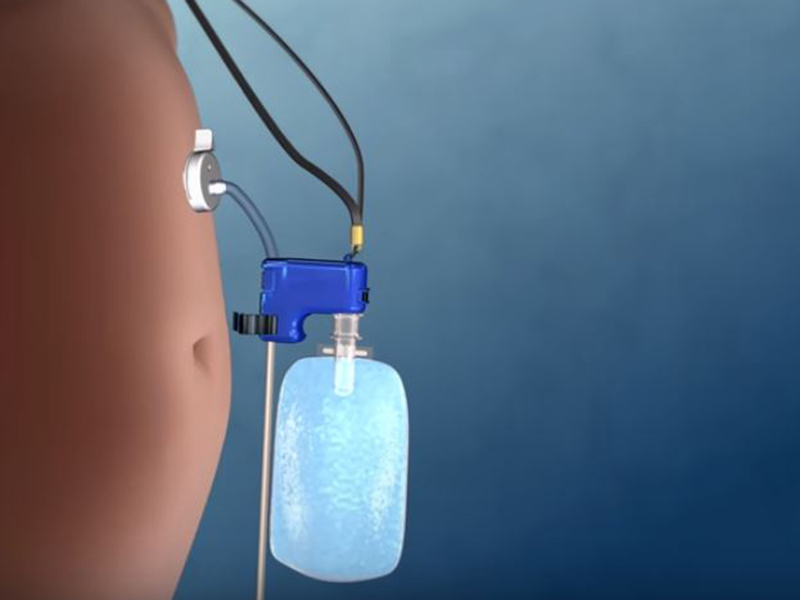 FDA approves 'abdominal vomiting' weight-loss device